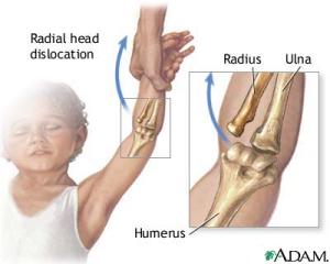 Nursemaid's Elbow